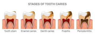 Root canal treatment (RCT)