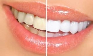Teeth Cleaning & Bleaching