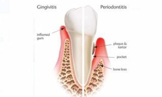 Advanced gum Treatments