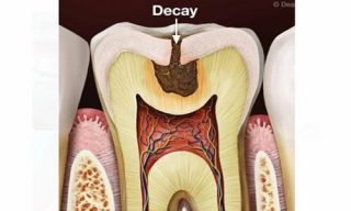 Cavity Protection
