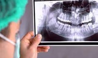 Digital RVG X – Rays