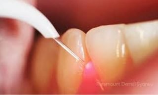 Laser Surgery
