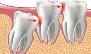 Wisdom Tooth Removal