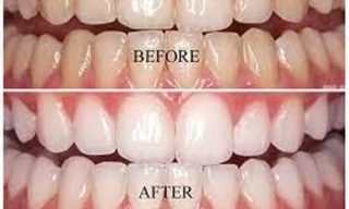 Teeth Whitening