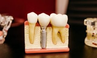 dental implants/fix tooth